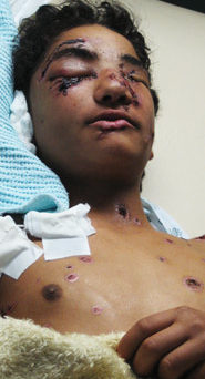 Gaza_enfant_brule_phosphore.jpg