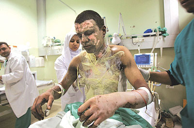 phosphore_blanc_enfant_gaza_brule.jpg