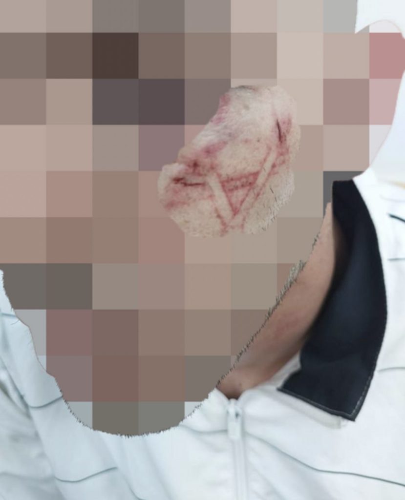 Un Palestinien marqué d’une Étoile de David au visage par la soldatesque israélienne ! (photo)
