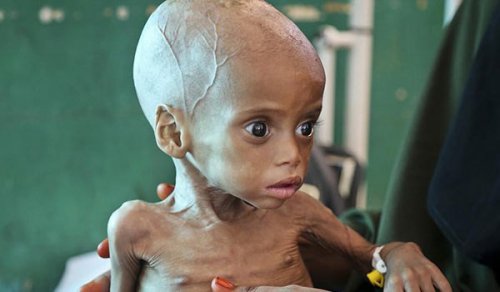 enfant_de_charne_famine_yemen.jpg