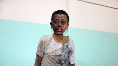 un-enfant-yemenite-attend-d-etre-pris-en-charge-dans-un-hopital-apres-avoir-ete-blesse-dans-une-frappe-sur-la-province-rebelle-de-saada-le-9-aout-2018_6098213.jpg